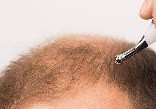 What is the procedure for Hair Transplant Repair?