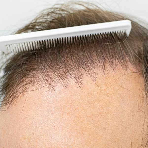 Hair Transplant Repair in Delhi