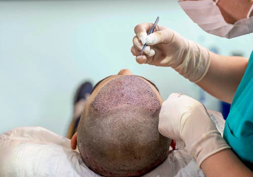 Holding Solutions Used By Top 5 Hair Transplant Clinic in Faridabad