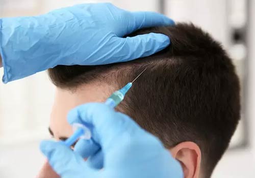 HOW MANY GRAFTS DO I NEED FOR THE HAIR RESTORATION TREATMENT?