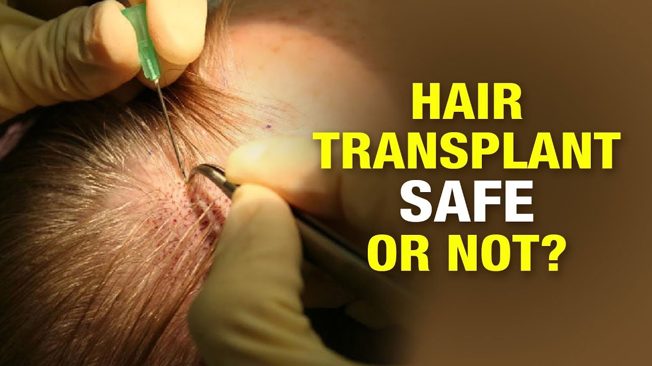 Hair Transplant Surgery in Delhi-NCR- Procedure