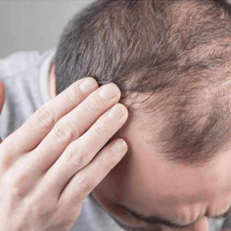 BIO FUE Hair Transplant Cost in Pandara Road