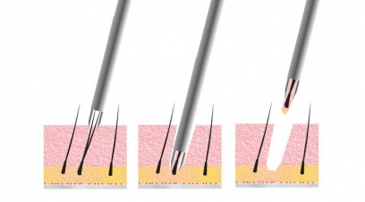 FUE Hair Transplant Cost in Ambala