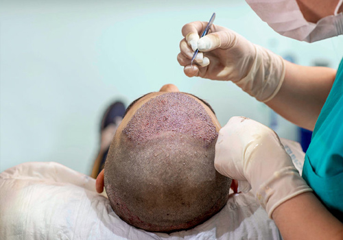 IS TREATMENT DONE BY A HAIR TRANSPLANT DOCTOR/SURGEONS PAINFUL?