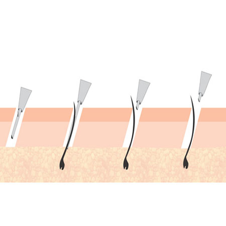 MDFI Hair Transplant in Rajendra Nagar