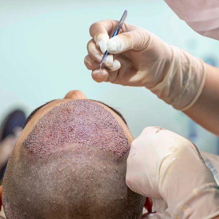 Hair Transplant in Defence Colony