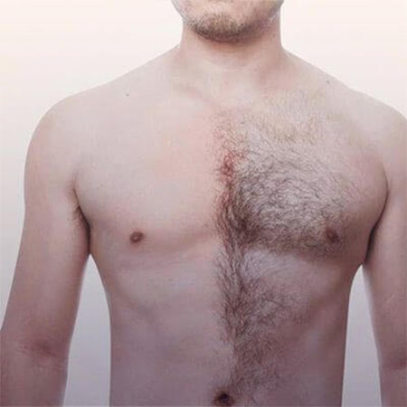 Body Hair Transplant in Ghaziabad