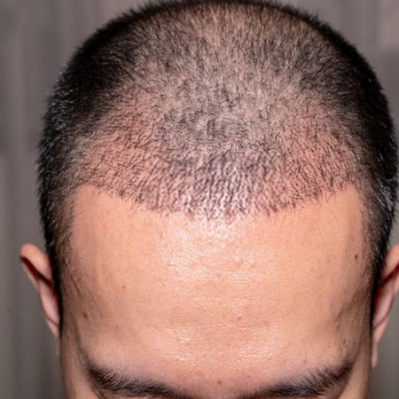 FUE Hair Transplant in Gurugram