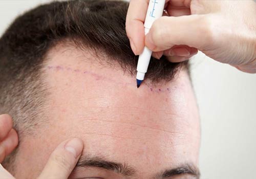 Procedure followed by top 5 hair transplant clinic in Maujpur