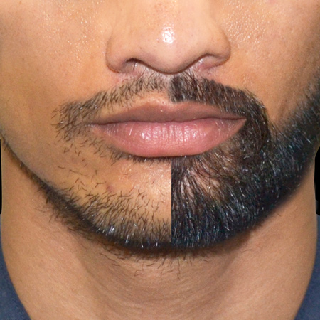 Beard Hair Transplant Cost in Delhi-NCR