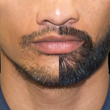 Beard Hair Transplant Cost in Dwarka