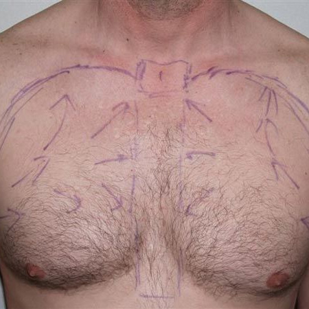 Body Hair Transplant Cost in Molarband