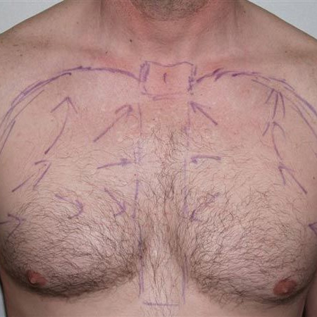Body Hair Transplant Cost in Delhi-NCR