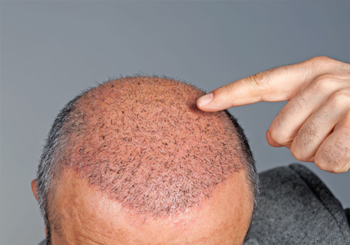 Hair Transplant Surgeons in Jama Masjid