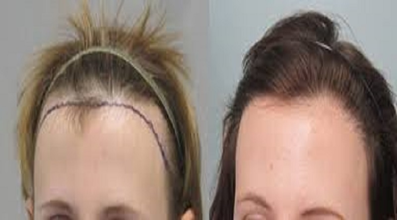 Female Hair Transplant Cost in Bangalore