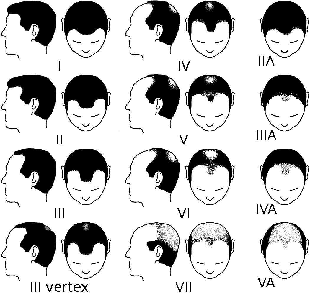 What are the Grades of Baldness?