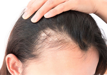WHAT ARE THE OTHER WAYS FOR HAIR LOSS TREATMENT IN WOMEN?