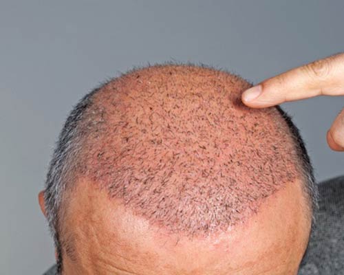 What is a Graft / Hair Follicle?