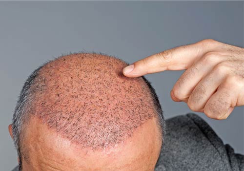 Why choose us as the best hair transplant in Sabzi Mandi?