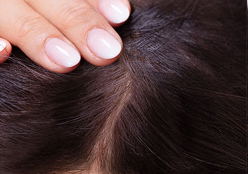 WOMEN/FEMALE HAIR TRANSPLANT AFTER-SURGERY