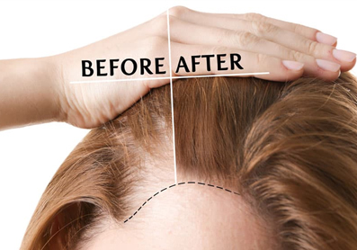 Women/Females Hair Transplant Procedure