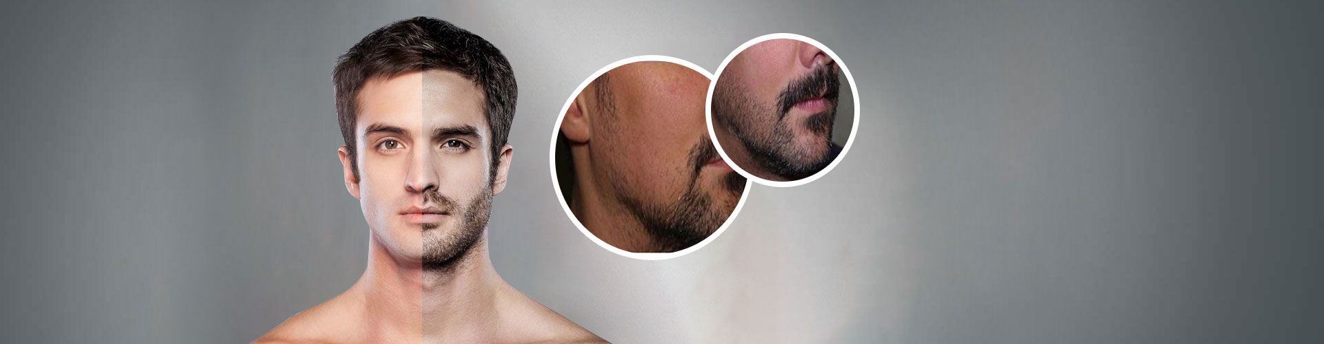 Beard Hair Transplant in Aps Colony