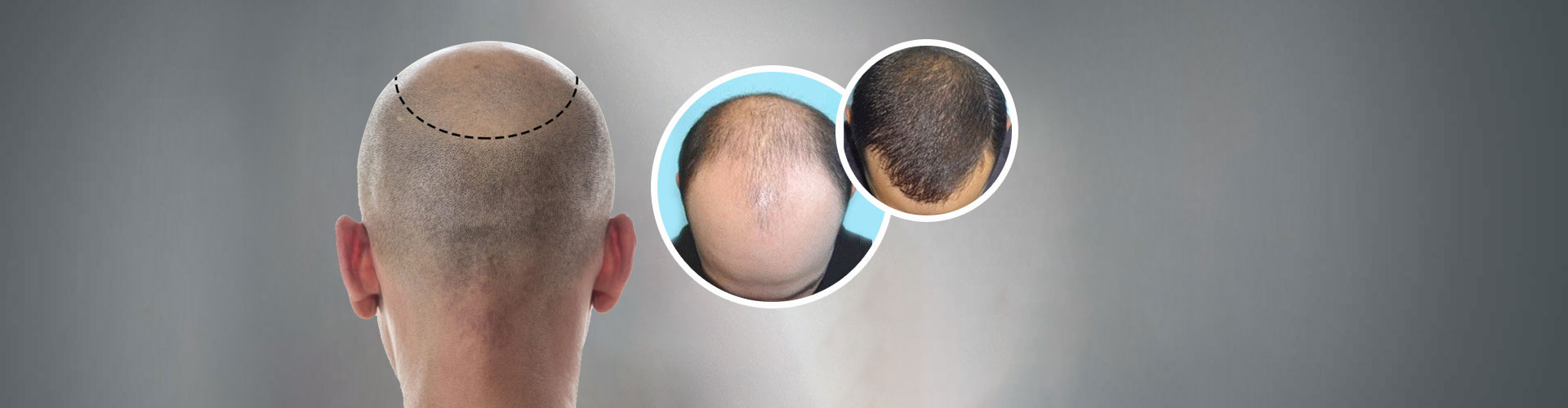 Bio FUE Hair Transplant in Shivalik