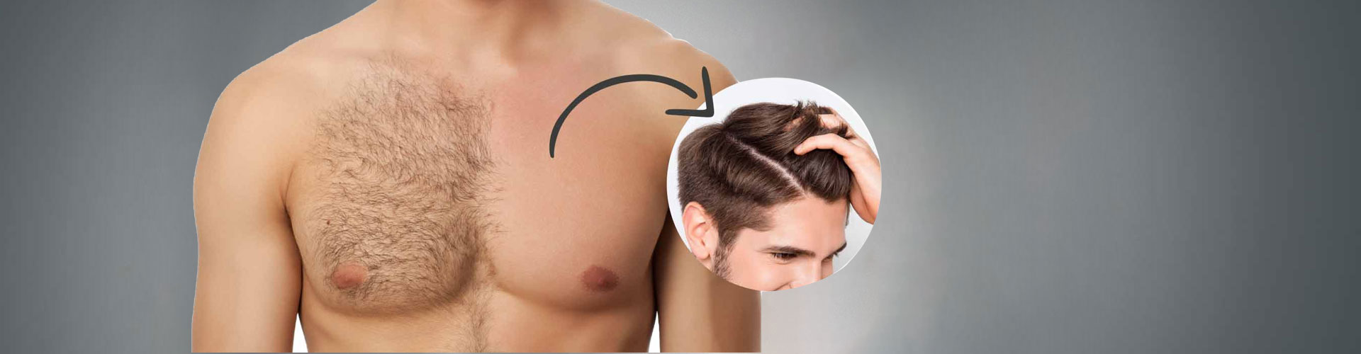 Body Hair Transplant in Chanakyapuri