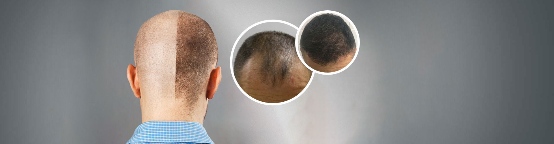 FUE Hair Transplant in Ambala Cantt