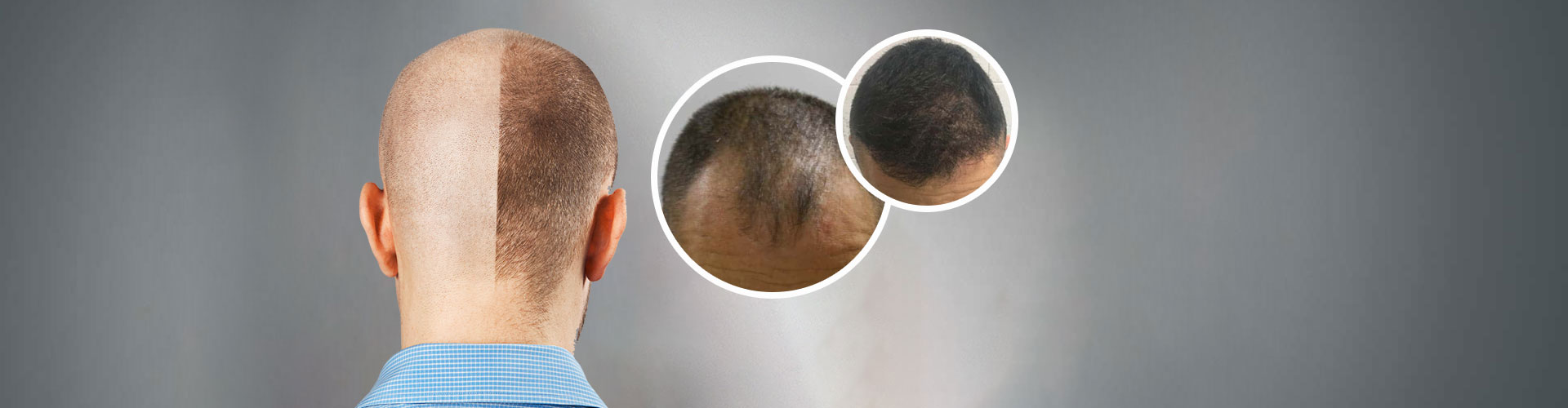 FUE Hair Transplant