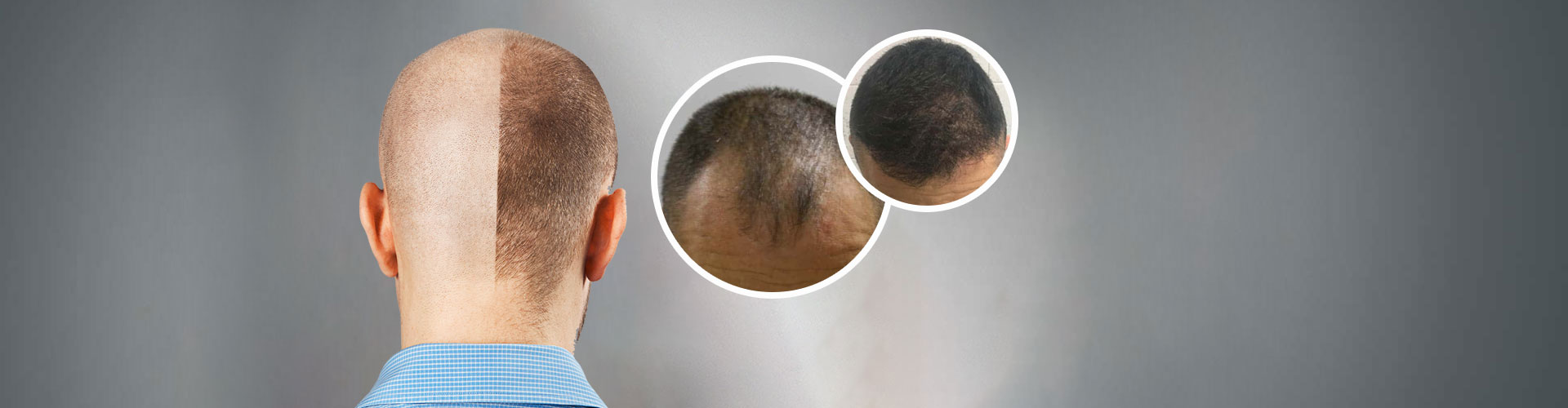 FUE Hair Transplant in Dakshinpuri