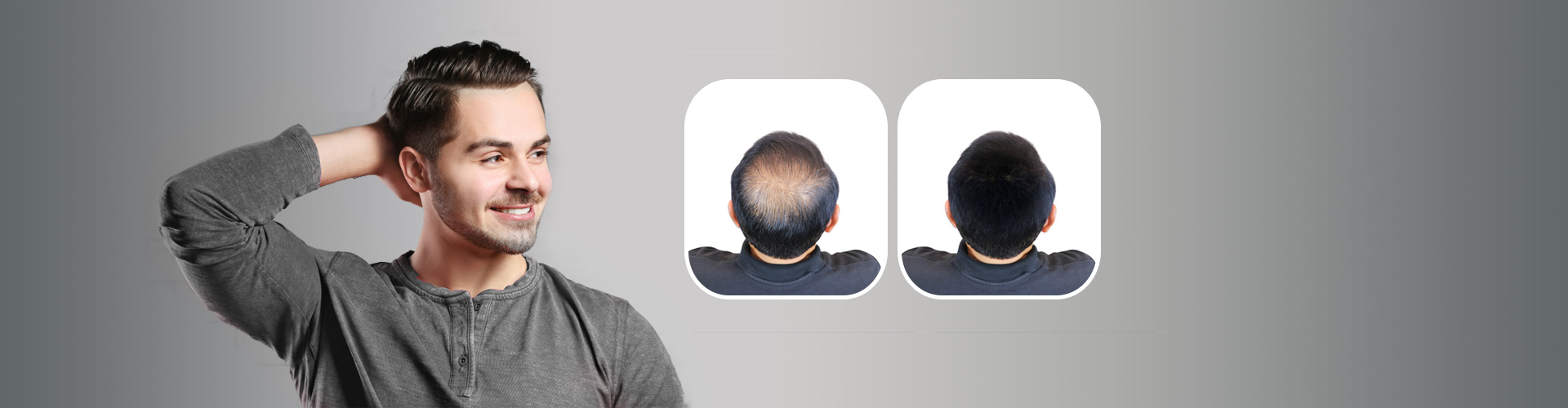 Hair Transplant Clinic in Model Town