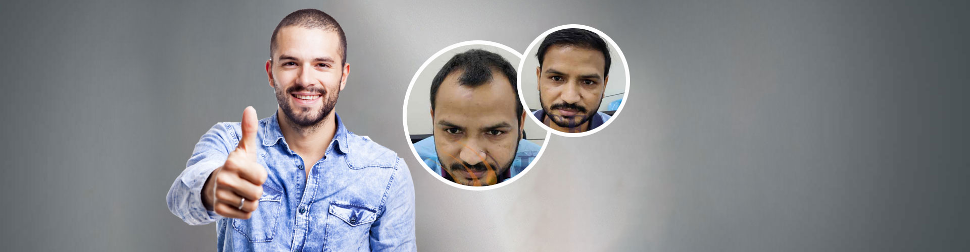 Hair Transplant Repair in Noida