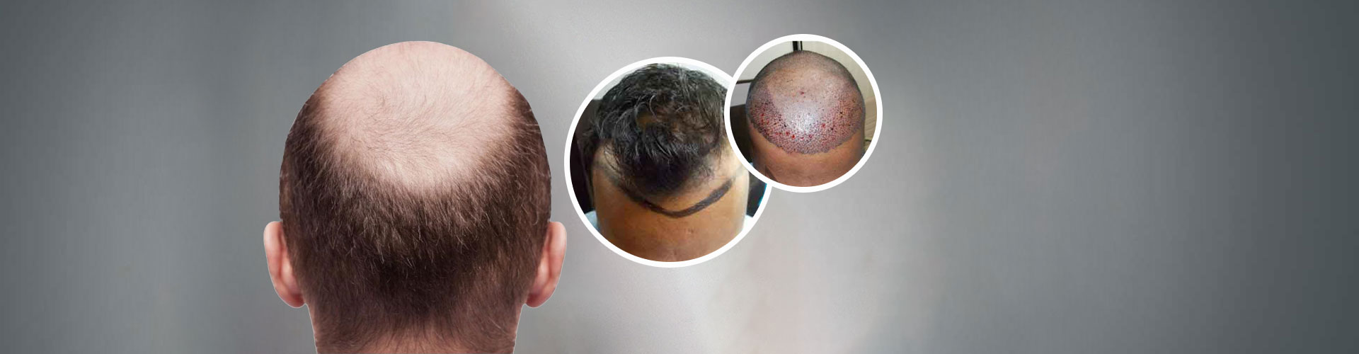 MDFI Hair Transplant in Malviya Nagar