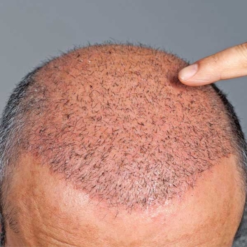 FUE Hair Transplant in Firozabad