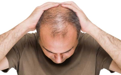 Hair Loss Treatment in Delhi