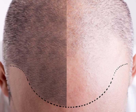 Hair Transplant Cost in Rithala