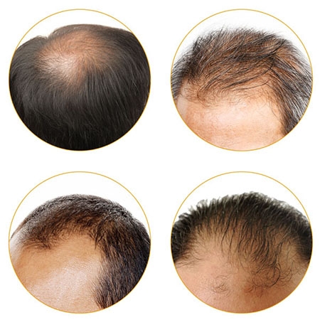 Types of Hair Loss in Chandni Chowk