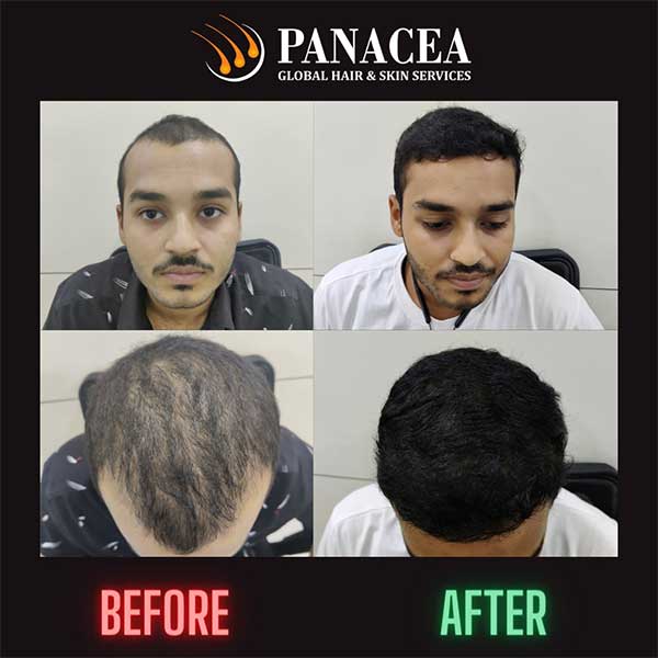 Before and After Hair Transplant Delhi
