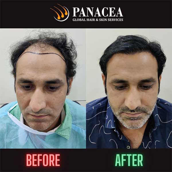 Panacea Global Hair Services - Before and After Result