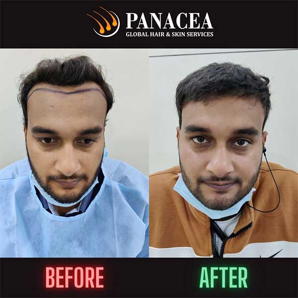 Hair Transplant Before and After 3000 Grafts Delhi