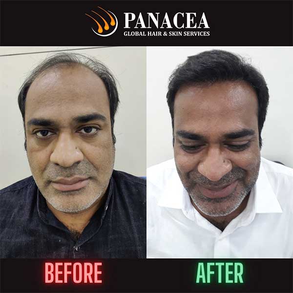 Hair Transplant in Delhi NCR After and Before Result