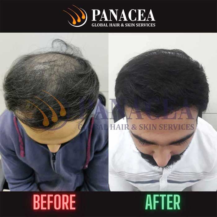 Panacea Real Result - Hair Transplant