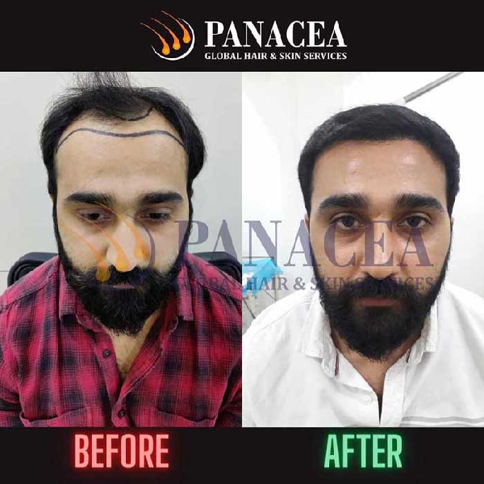 Hair Transplantation Delhi - Panacea Real Result