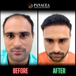 Before and After Hair Transplant Result