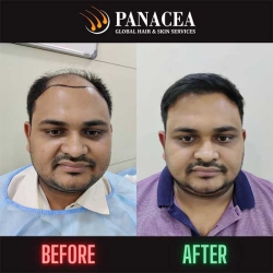 Before and After Hair Transplant in Delhi