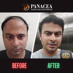Before and After Result - Hair Transplant in Delhi