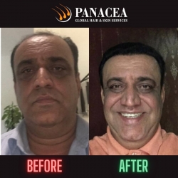 Hair Transplant - Before and After Result in Delhi