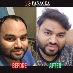 Hair Transplant - Before and After Result in Delhi