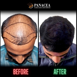 Hair Transplant - Before and After Result in Delhi